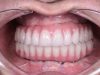 Full Mouth Reconstruction After