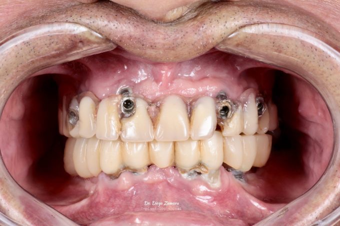 Full Mouth Reconstruction Before