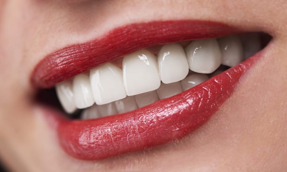 dental veneers