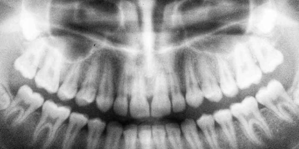 Digital Dental X-Rays Make it Easy to Get Your Dental Process Started