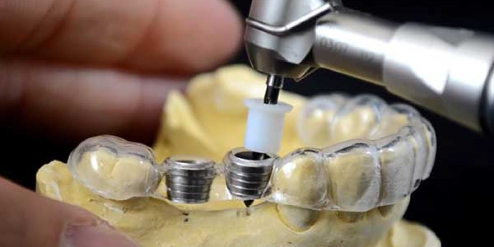 State-of-the-Art Surgical Guides Make Dental Implant Placement Less Invasive