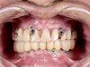 Full Mouth Reconstruction Before