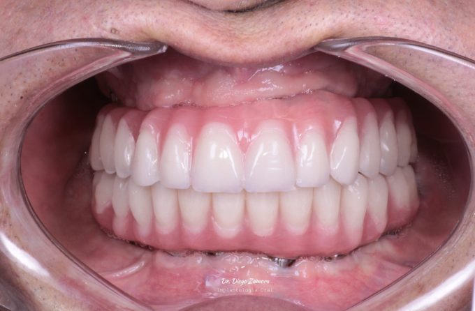 Full Mouth Reconstruction After