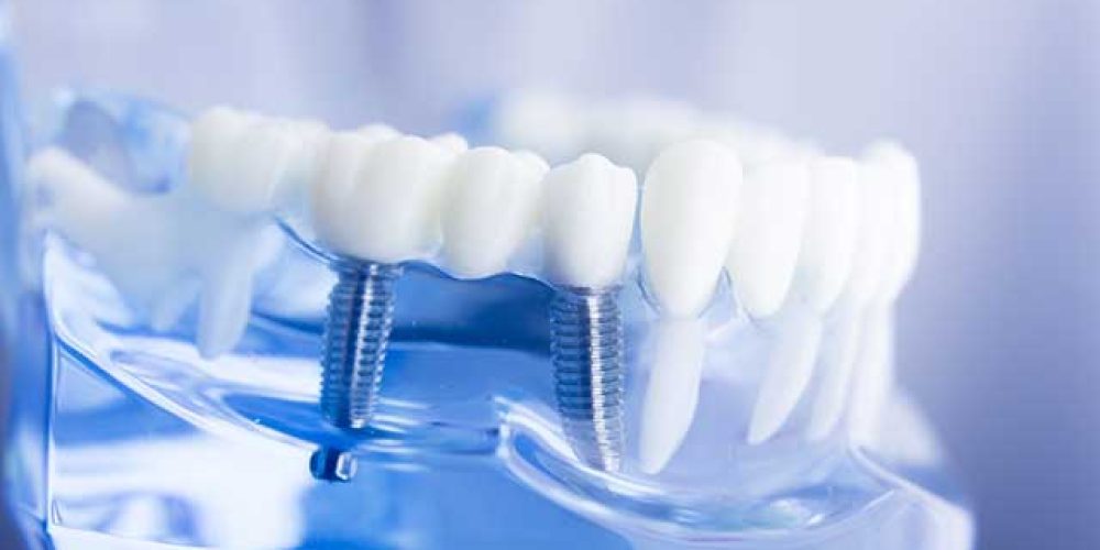 Surprising Benefits Of Prosthodontic Procedures