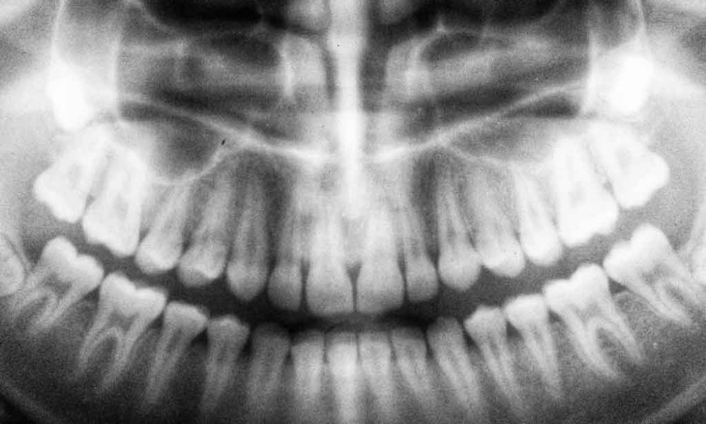 Digital Dental X-Rays In Costa Rica