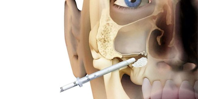 Improve Your Breathing with a Maxillary Sinus Lift