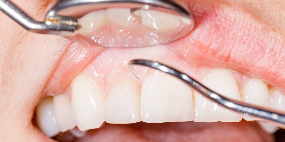 Crown Lengthening To Fix A Gummy Smile