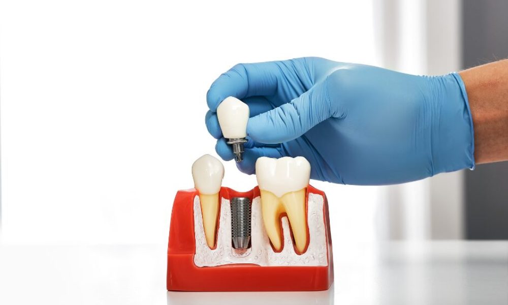 Quality and Safety of Dental Implants in Costa Rica