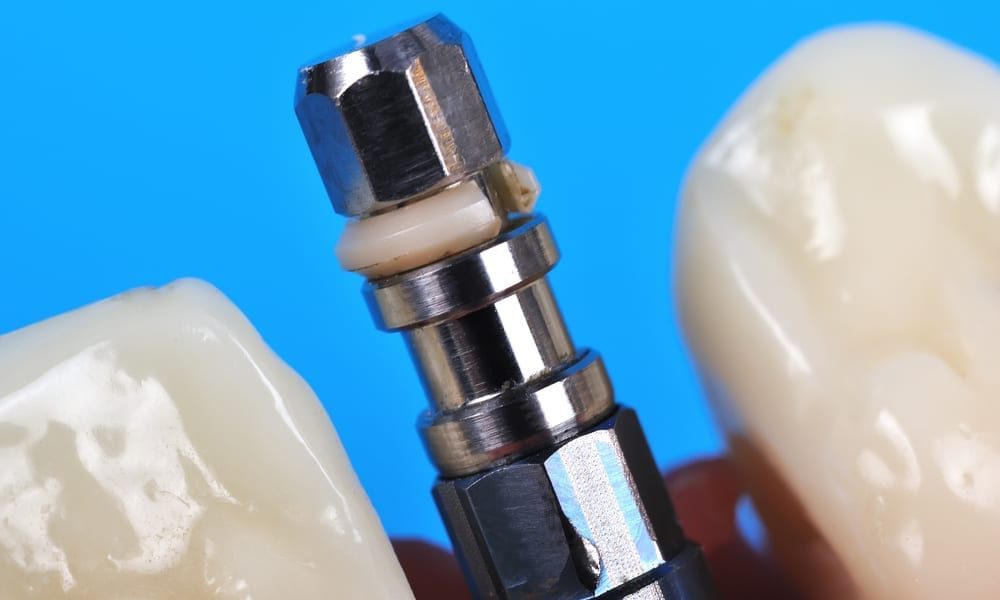 Dental Implant