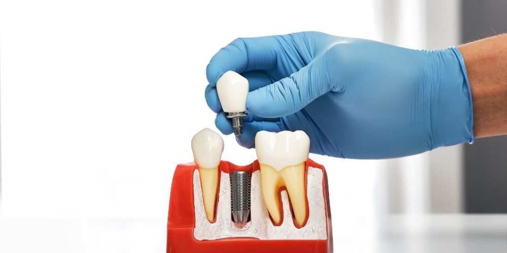 Quality and Safety of Dental Implants in Costa Rica