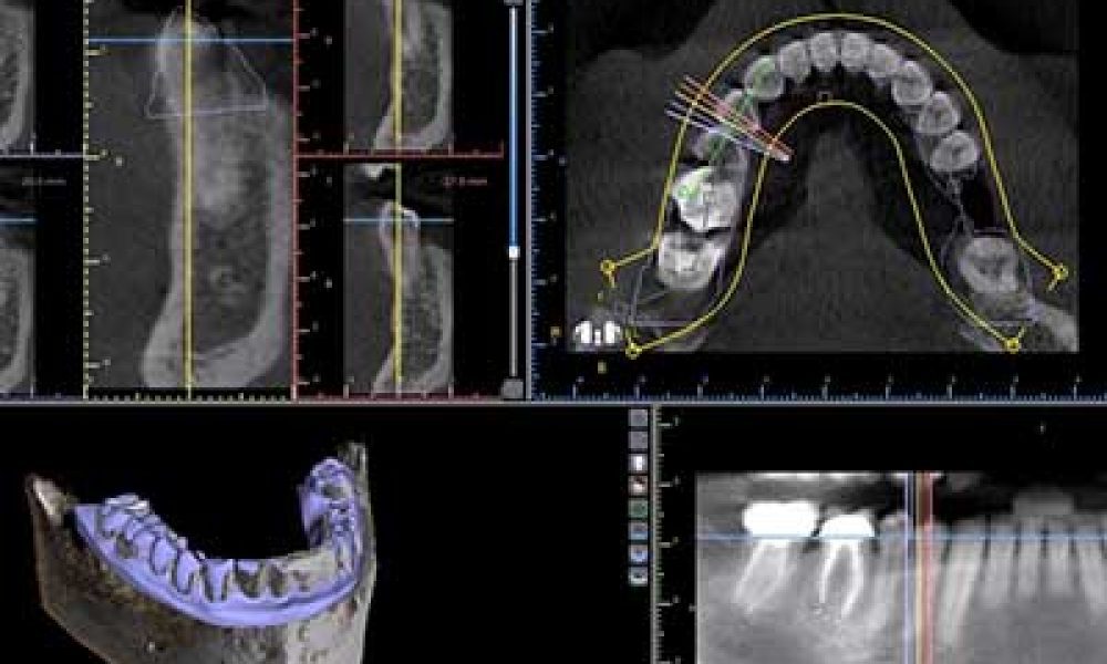 Costa Rica surgical guides