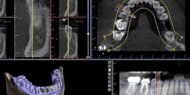 Surgical Guides Aid in Best Placement of Dental Implants
