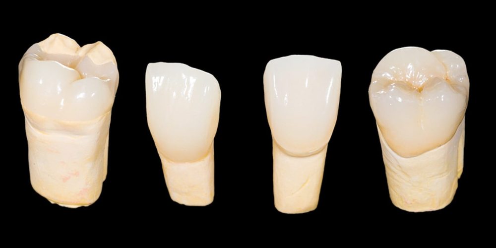 Zirconia Crowns & Bridges in Costa Rica