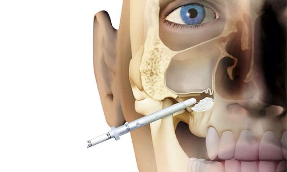 Maxillary Sinus Lift