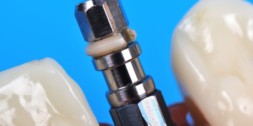 Save Money on Dental Implants in Costa Rica