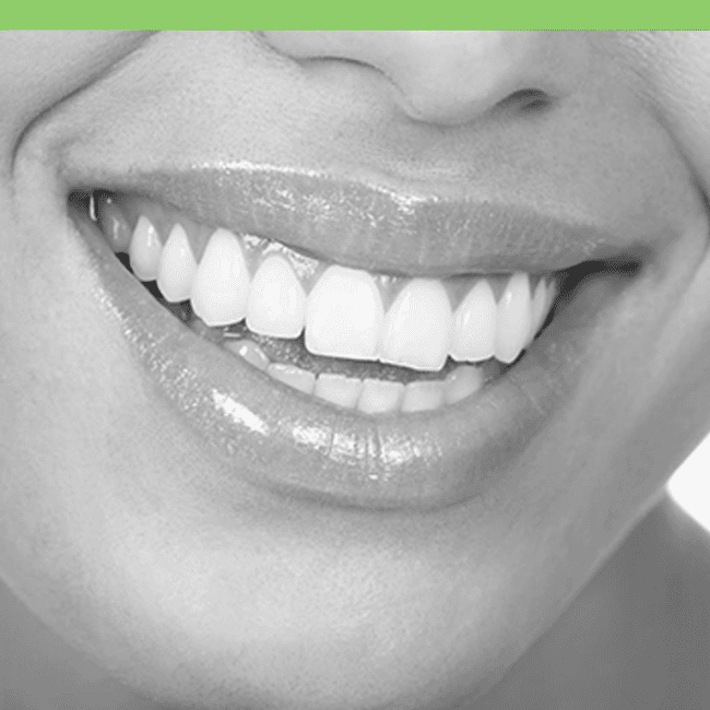 Full Mouth Restoration