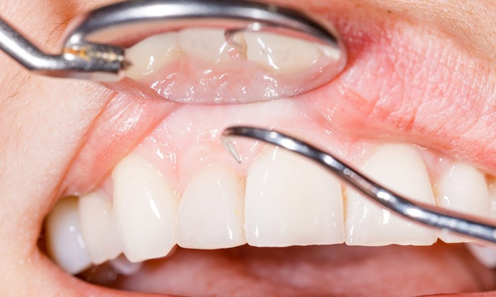 crown lengthening